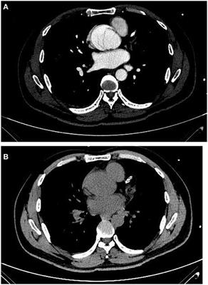 Case Report: Intraoperative Open-Heart Coronary Angiography in Acute Type A Aortic Dissection